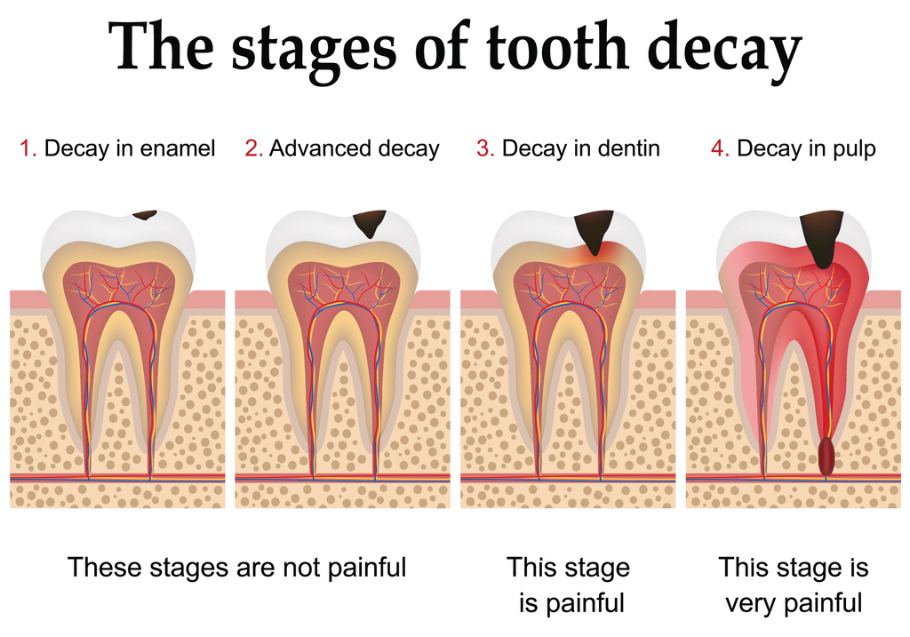 The stages of tooth decay