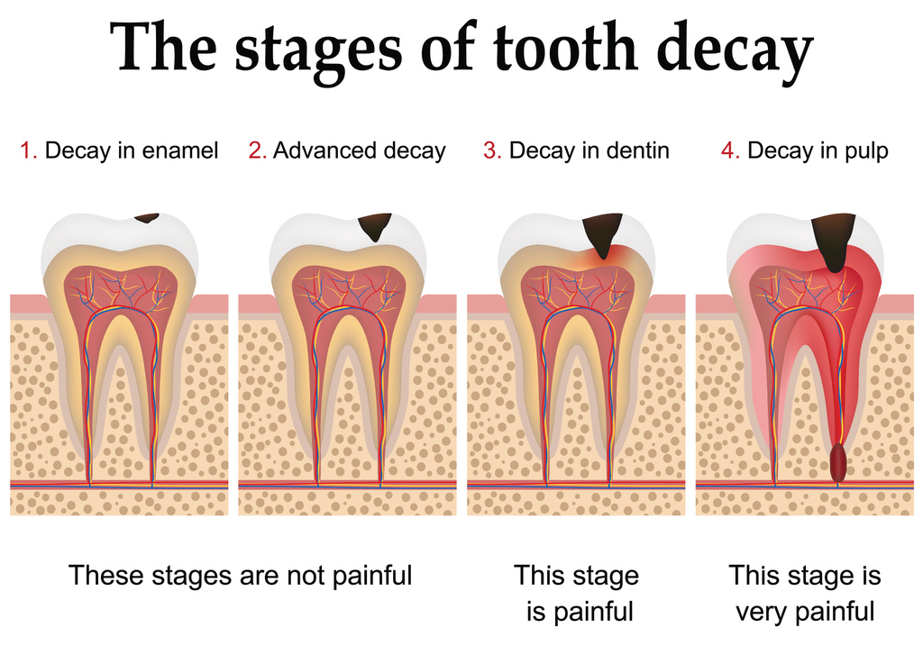 how-to-cure-teeth-cavities-naturally-at-home-get-rid-of-dental