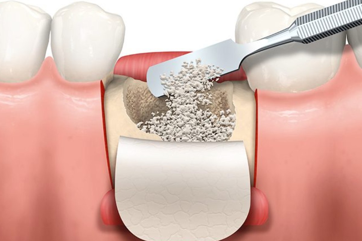 Bone Grafting